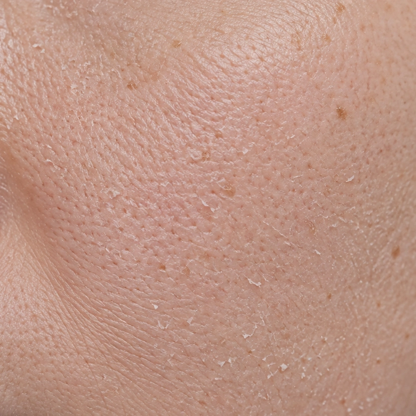 Illustrative close-up cheek skin, before state